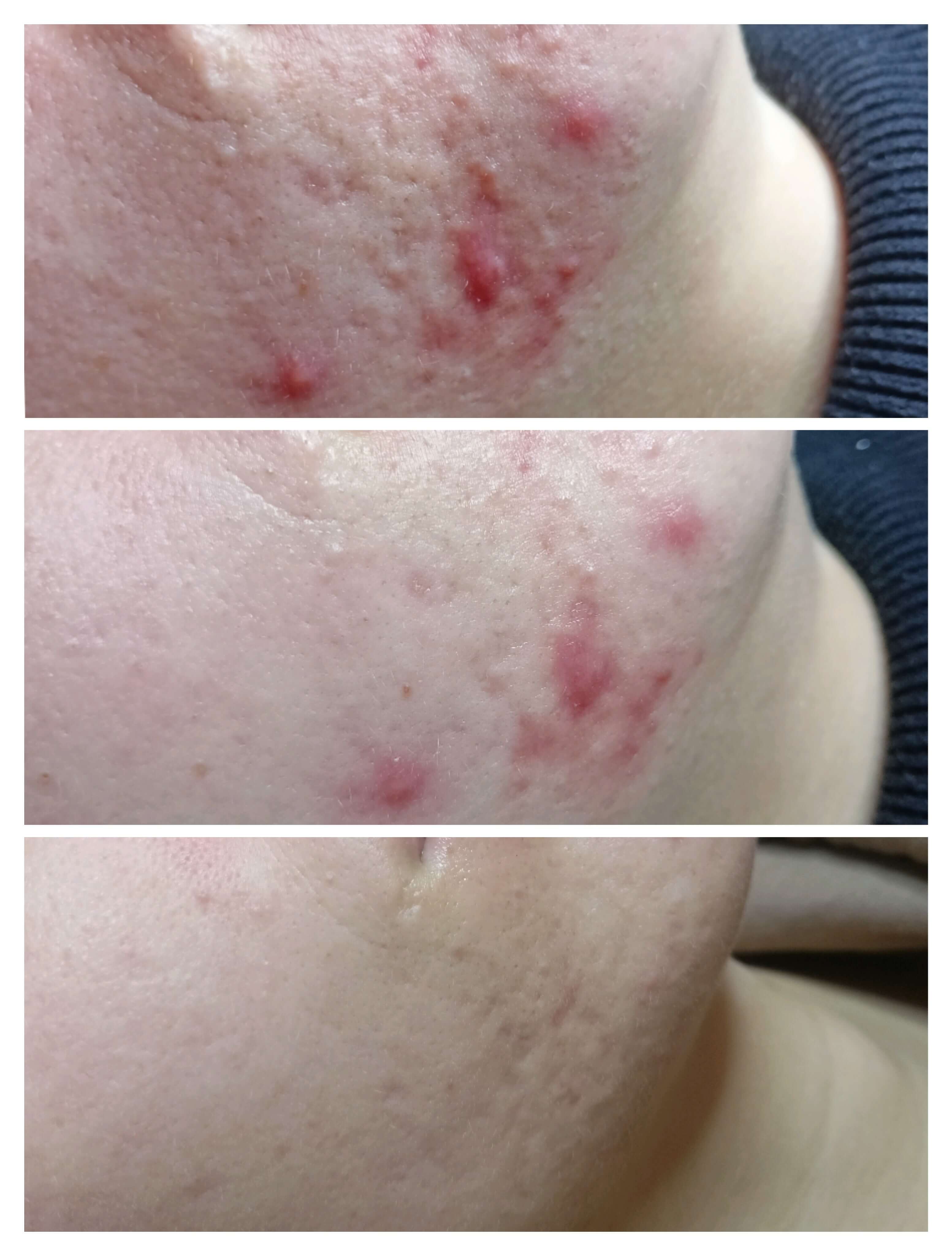 Acne vulgaris